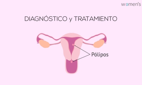Pólipo endometrial ¿Que es? Diagnóstico y tratamiento
