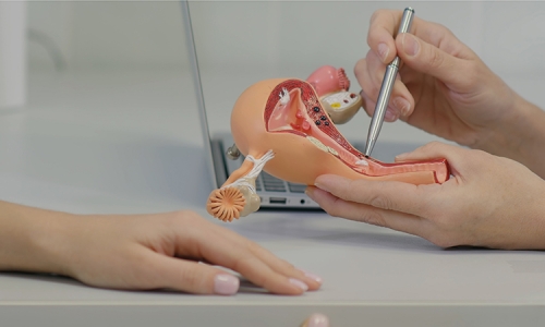 Mioma uterino: ¿Que es? Diagnóstico y tratamiento.